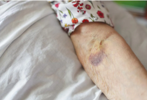 إصلاح تمدد أو انسداد شرايين اليدين والقدمين