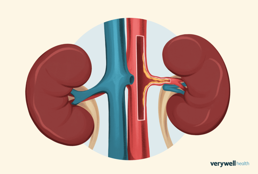  ارتفاع ضغط الدم الكلوي بسبب ضيق الشريان الكلوي
