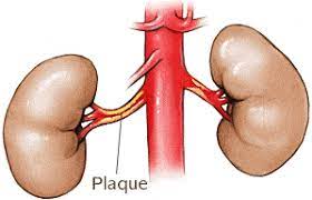 ارتفاع ضغط الدم الكلوي بسبب ضيق الشريان الكلوي