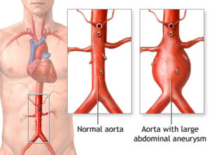 نمدد الشريان الاورطى