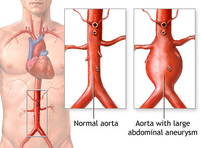 نمدد الشريان الاورطى