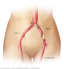 انسداد الشرايين الطرفية 2