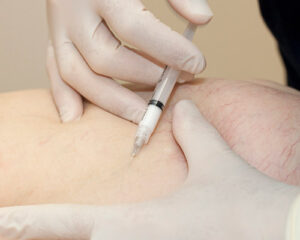 علاج الدوالى بالحقن